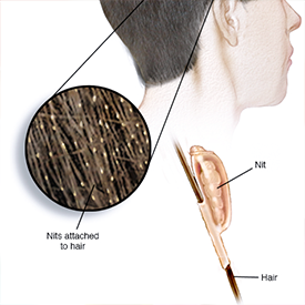 Lice Clinics of America - Long Island Head lice diagram
